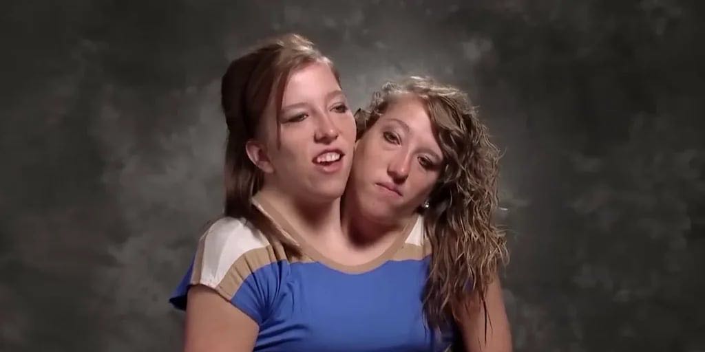 La inspiradora vida de las siamesas Abby y Brittany Hensel, una historia que desafía los límites